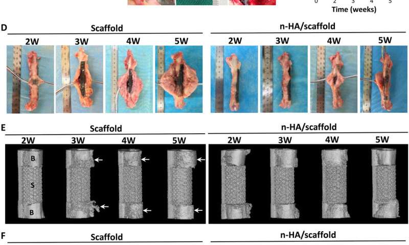 Application of hydroxyapatite nanoparticles (n-HA) in tumor-associated bone segmental defect