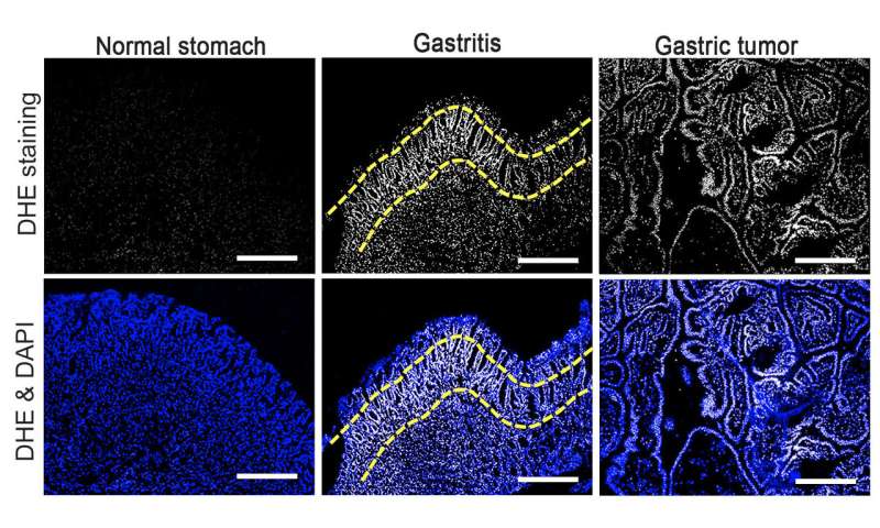 New study explains how inflammation causes gastric cancer