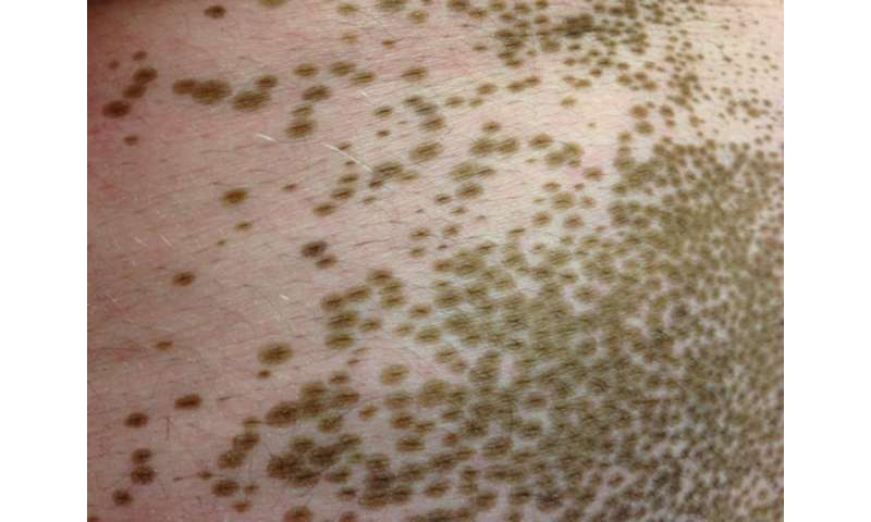 New treatment in the works for disfiguring skin disease, vitiligo