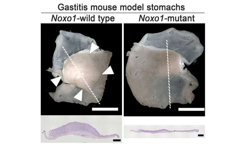 New study explains how inflammation causes gastric cancer