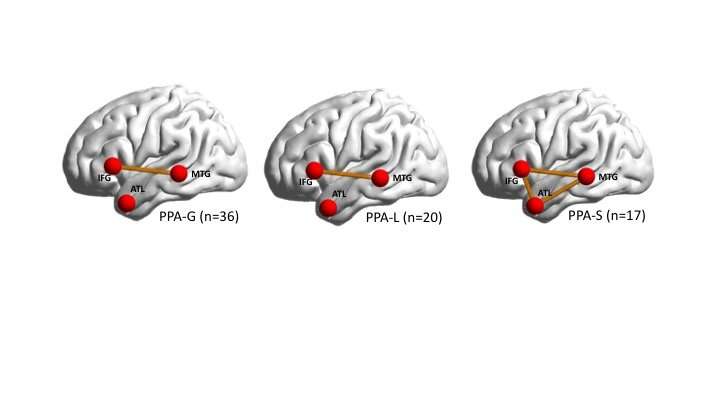 Map of broken brain networks shows why people lose speech in language-based dementia