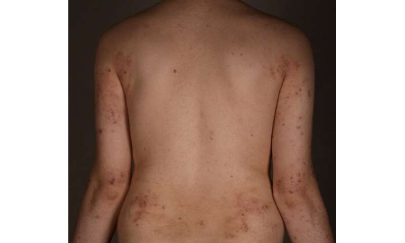 New potential approach to treat atopic dermatitis