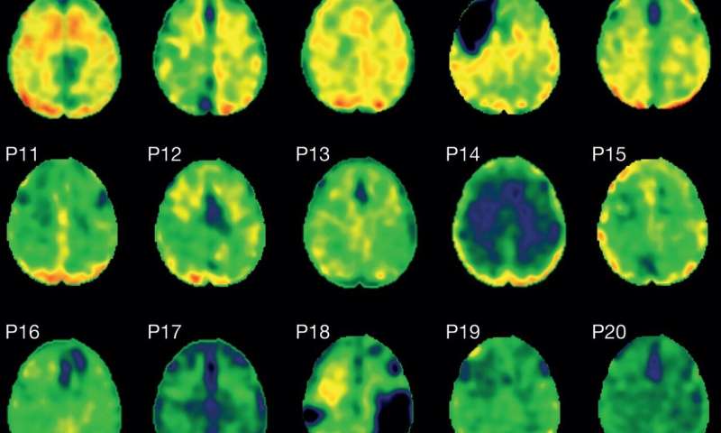Protein tangles linked with dementia seen in patients after single head injury