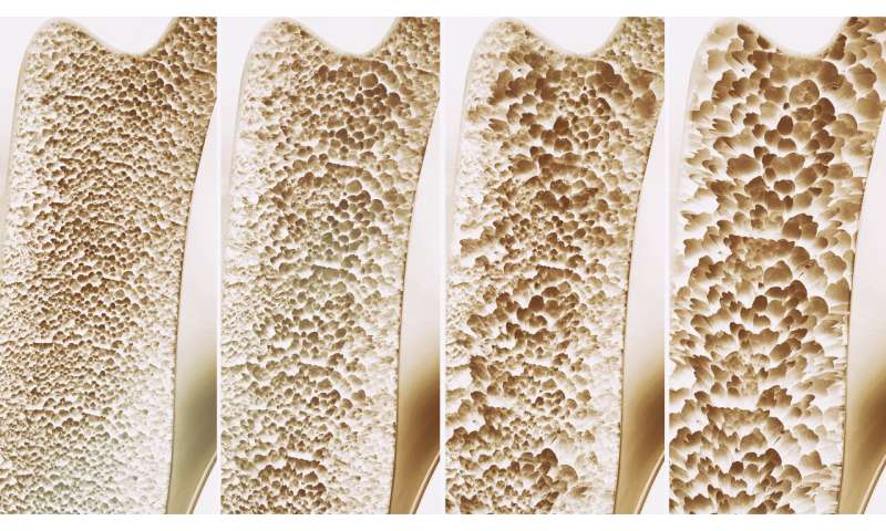 UTSA studies osteoporotic bone fractures to rethink treatment