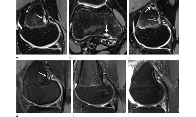 Irregular findings common in knees of young competitive alpine skiers
