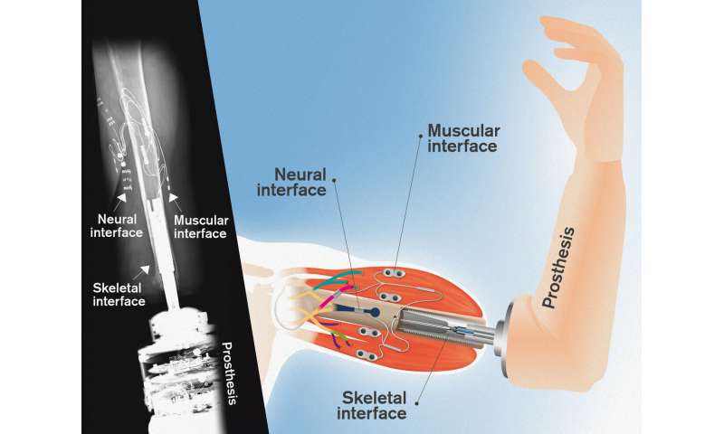Mind-controlled arm prostheses that 'feel' are now a part of everyday life