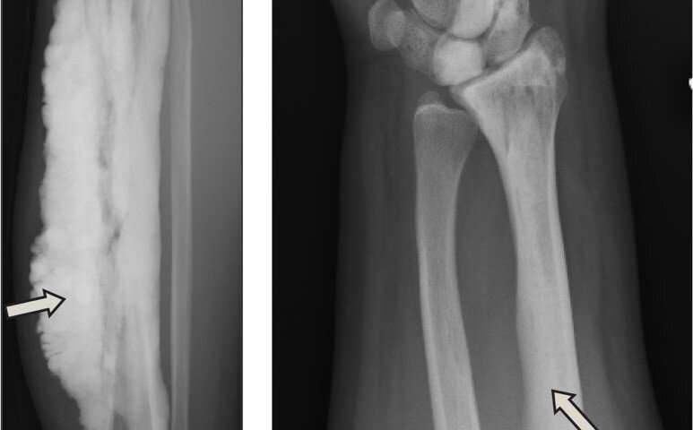 Researchers discover gene for rare disease of excess bone ...