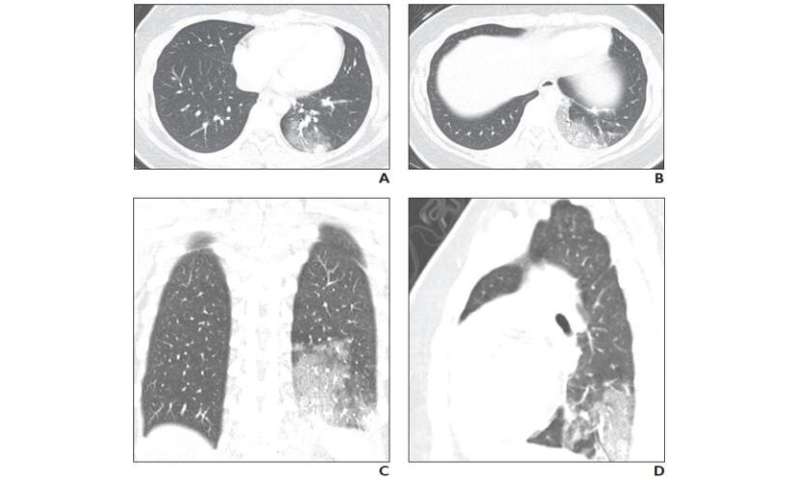小儿冠状病毒病(COVID-19) x光,CT检查的肺部疾病
