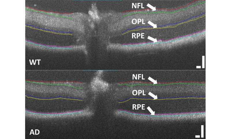 Retinal texture could provide early biomarker of Alzheimer's disease