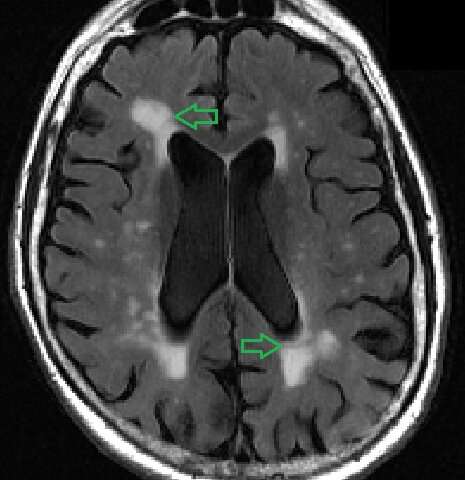 'White matter lesion' mapping tool identifies early signs of dementia