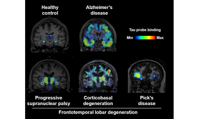 Brain imaging of tau protein in various forms of dementia