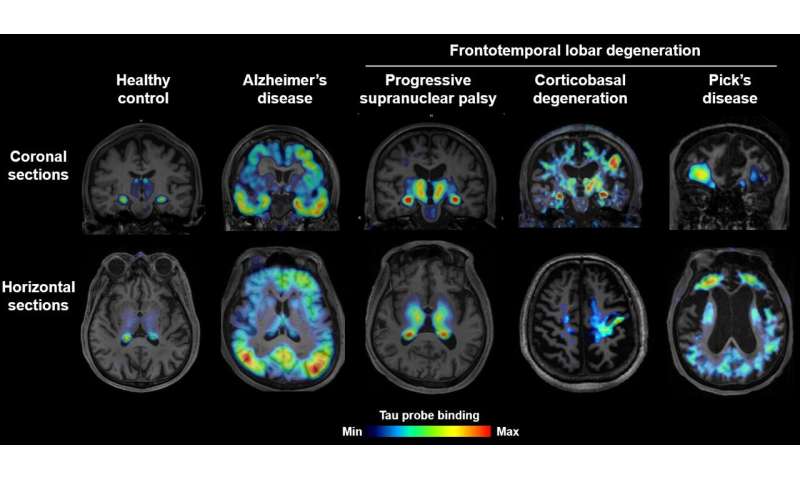 Brain imaging of tau protein in various forms of dementia