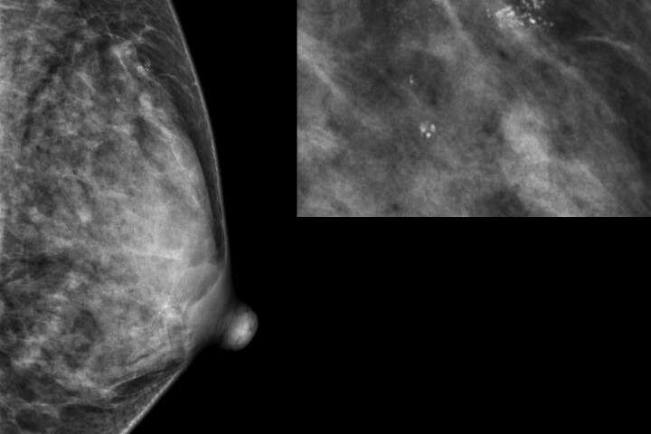 Researchers reveal which benign breast disease is most likely to develop into cancer