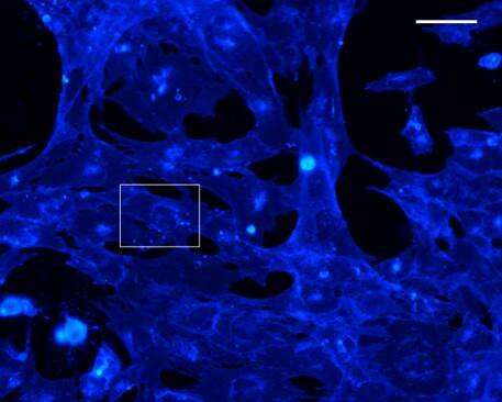 New brain alterations induced by main genetic risk factor in Alzheimer's disease discovered