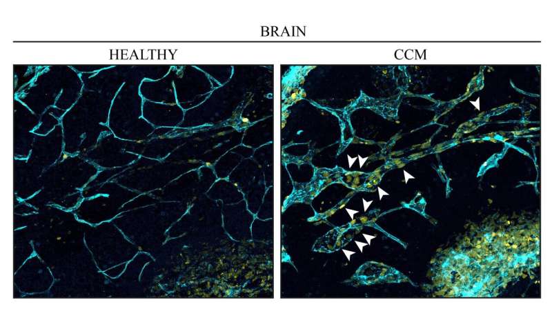 Venous origin of brain blood-vessel malformations