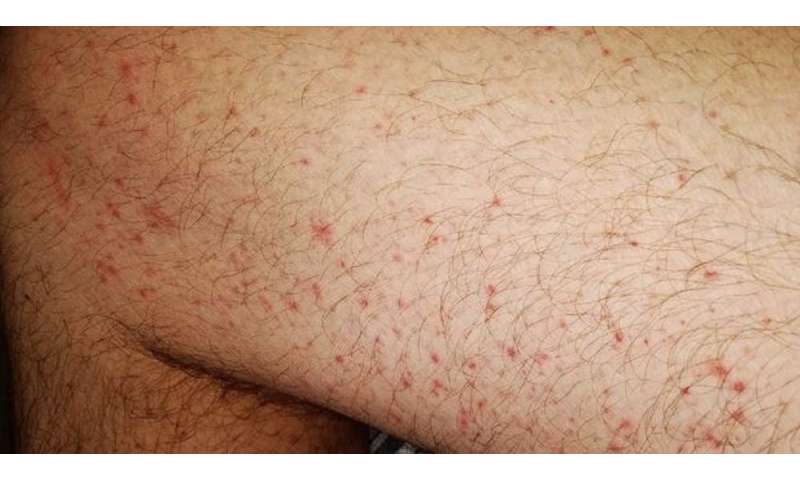 冠状病毒影响皮肤的8种方式，从冠状病毒脚趾，到皮疹和脱发