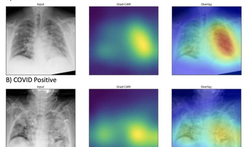 AI detects COVID-19 on chest x-rays with accuracy and speed