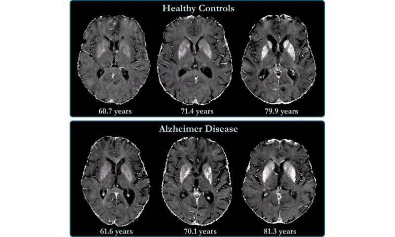 Brain iron accumulation linked to cognitive decline in Alzheimer's patients