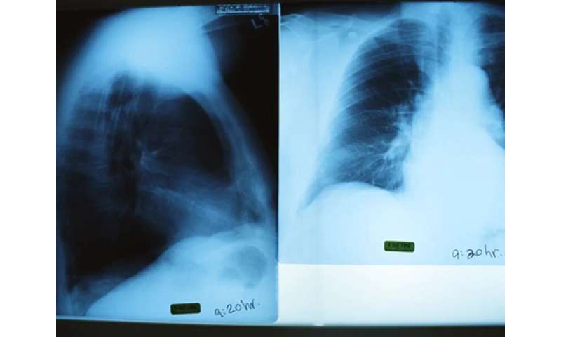Chest X-ray findings normal for many confirmed COVID-19 cases