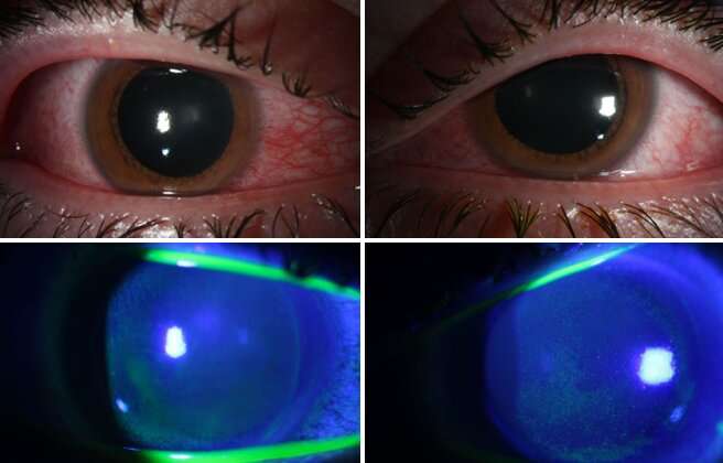 COVID collateral damage: germicidal lamps can damage corneas