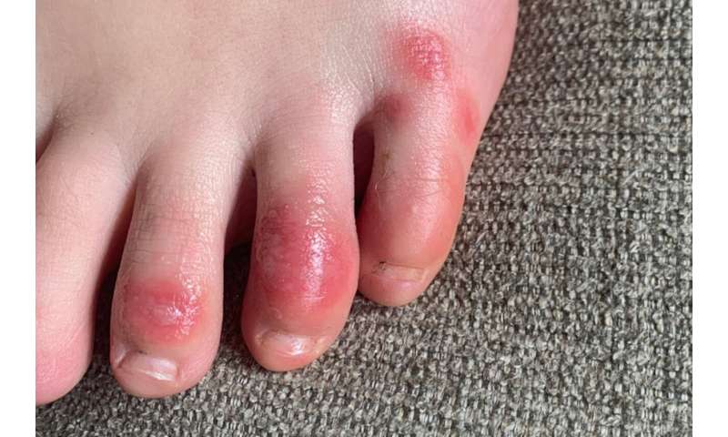 'COVID toes,' other rashes latest possible rare virus signs
