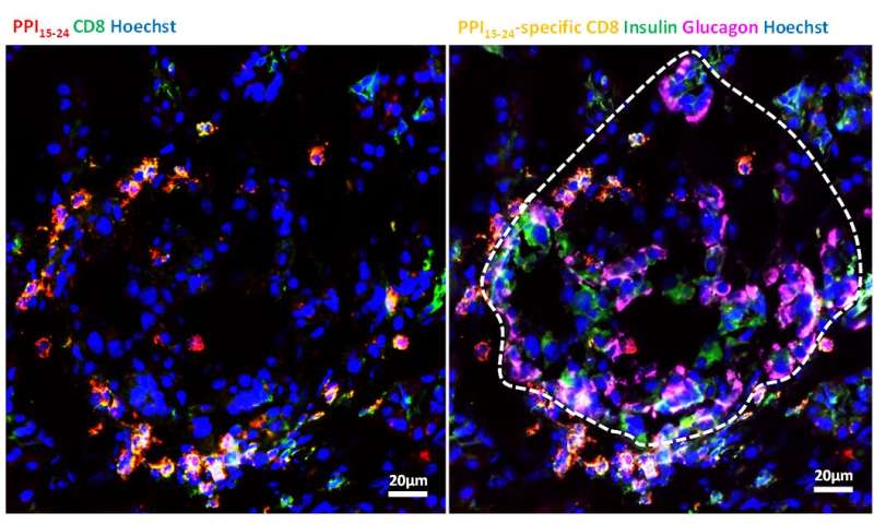 Diabetes researchers spot dangerous T cells in the pancreas -- even in healthy people