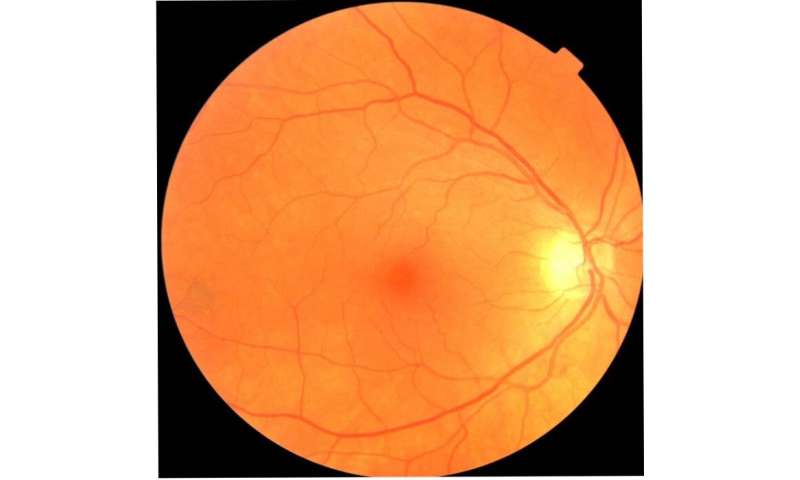 Eye exam could lead to early Parkinson's disease diagnosis