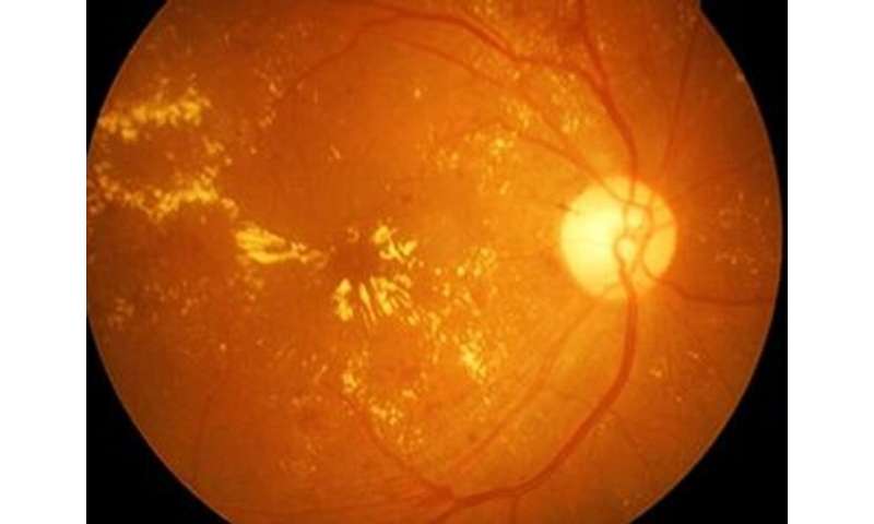 Female hormone rx not tied to retinal vascular occlusion