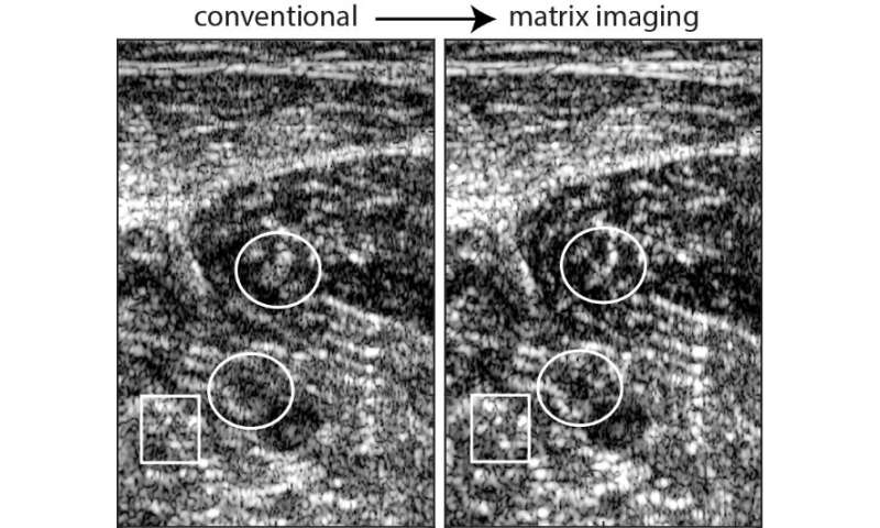 Matrix imaging: an innovation for improving ultrasound resolution