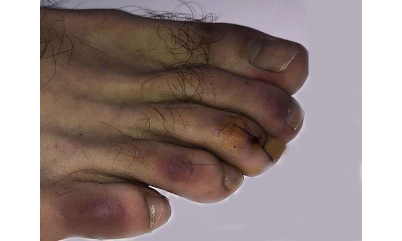 More symptoms of coronavirus: COVID toes, skin rashes