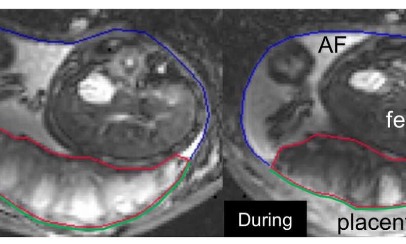MRI pregnancy study gives new insights into the all-important placenta
