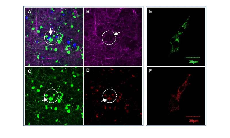 Protein associated with ovarian cancer exacerbates neurodegeneration in Alzheimer's