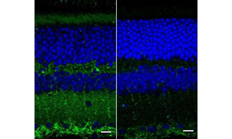 Retinal texture could provide early biomarker of Alzheimer's disease
