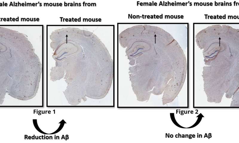 Sex-specific Alzheimer's treatment could benefit males over females