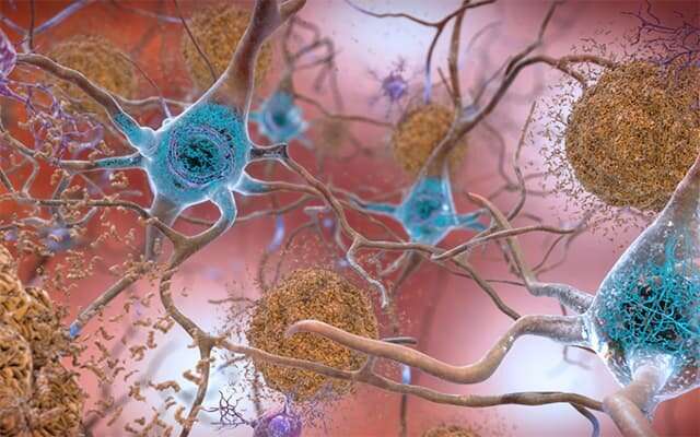 Subtle decline in cognition predicts progression to Alzheimer's pathology