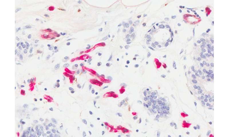 UofL researchers describe possible mechanism for link between obesity and breast cancer