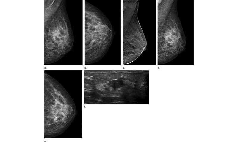指状乳腺层析成形术降低间隔期癌症的发病率