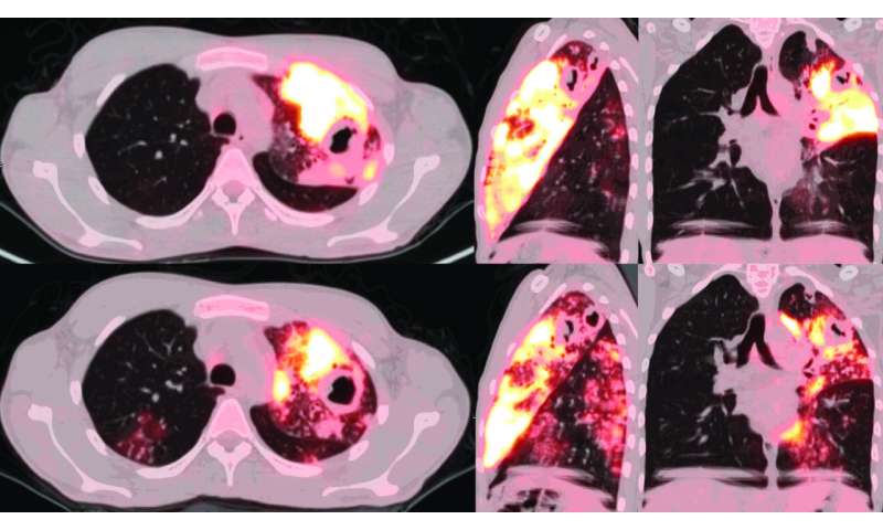PET和CT扫描提供肺部有活跃的TB的敏锐视图，比痰液测试更好的评估工具