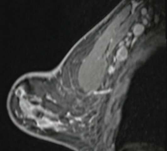 Covid 19 Vaccination Axillary Adenopathy Detected During Breast Imaging
