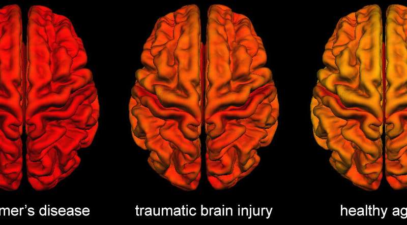 创伤性脑损伤后的大脑变化与阿尔茨海默病有相似之处