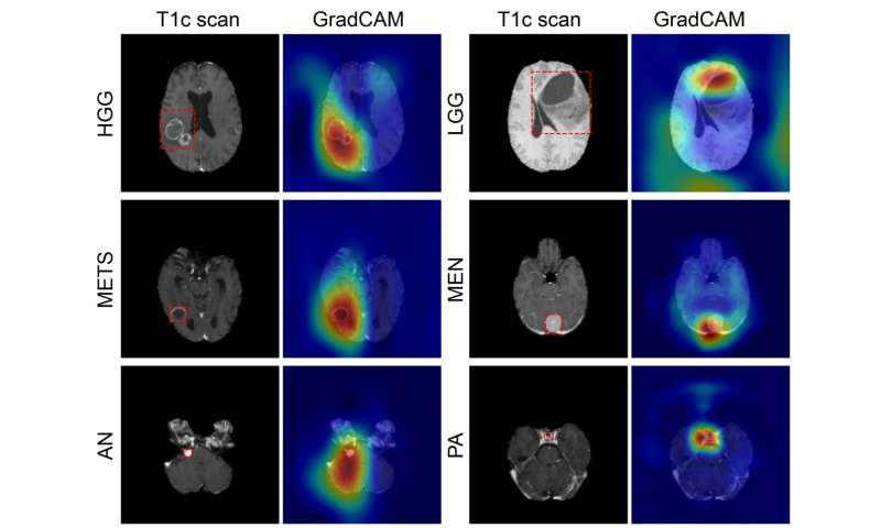 Deep learning model classifies brain tumors with single MRI scan