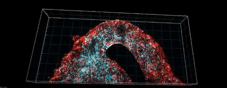 Prima biostampa 3D dell'intero tumore attivo