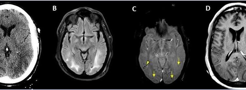 Un gran estudio internacional revela el espectro de complicaciones cerebrales de COVID-19