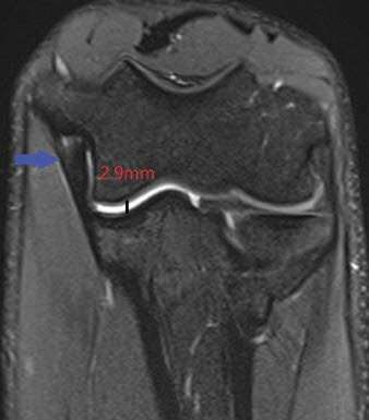 MLB 'FEVER' -- improved elbow MRI view for Major League Baseball pitchers