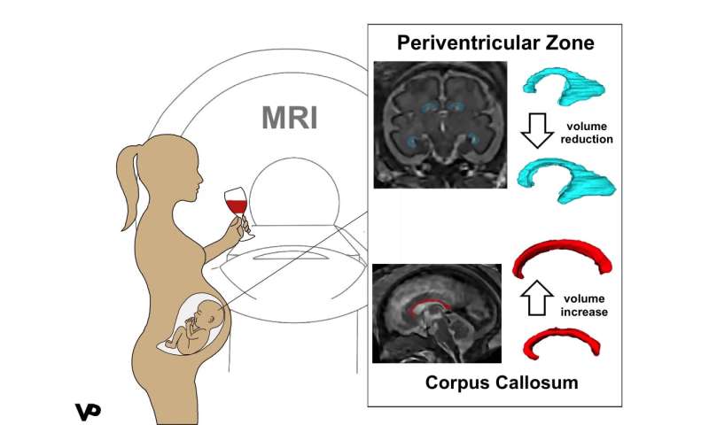 MRI reveals altered brain structure in fetuses exposed to alcohol