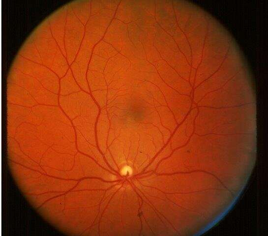 Routine eye scans may give clues to cognitive decline in diabetes