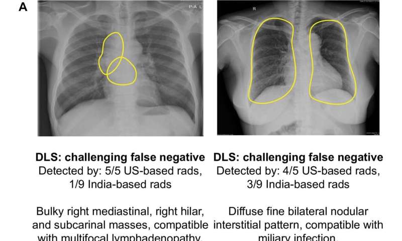 AI-based system shows promise in tuberculosis detection