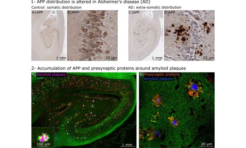 Alzheimer's disease: an alternative hypothesis based on synaptic alterations