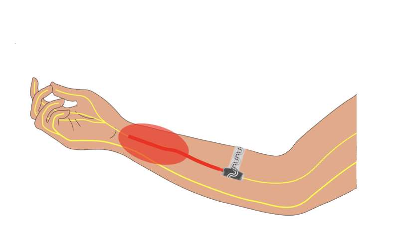 Dissolving implantable device relieves pain without drugs