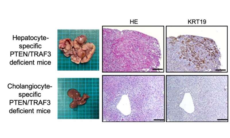 Molecular details of a dangerous form of liver cancer
